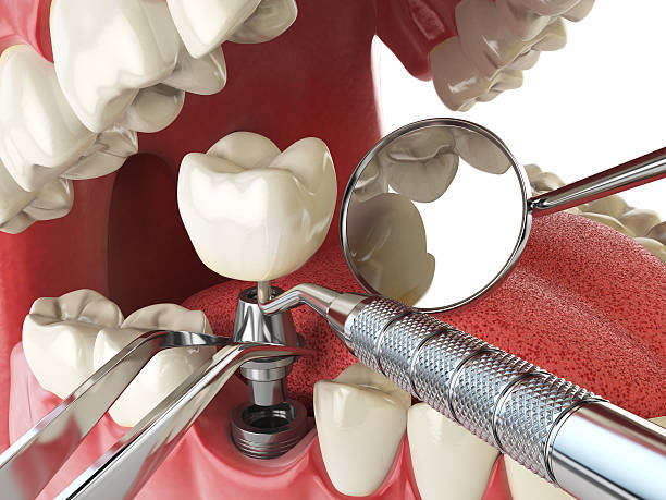 Best Emergency Tooth Extraction in Broadview Park, FL